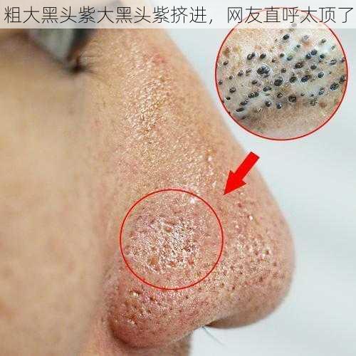 粗大黑头紫大黑头紫挤进,网友直呼太顶了