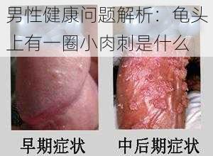 男性健康问题解析:龟头上有一圈小肉刺是什么