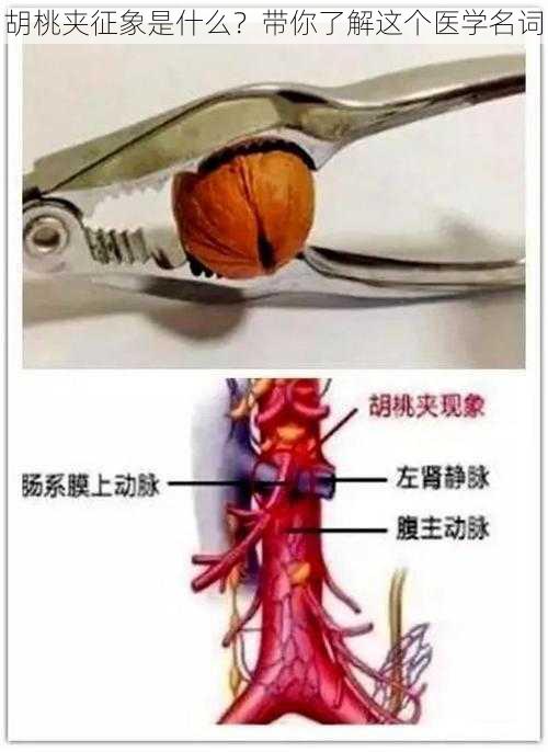 胡桃夹征象是什么?带你了解这个医学名词